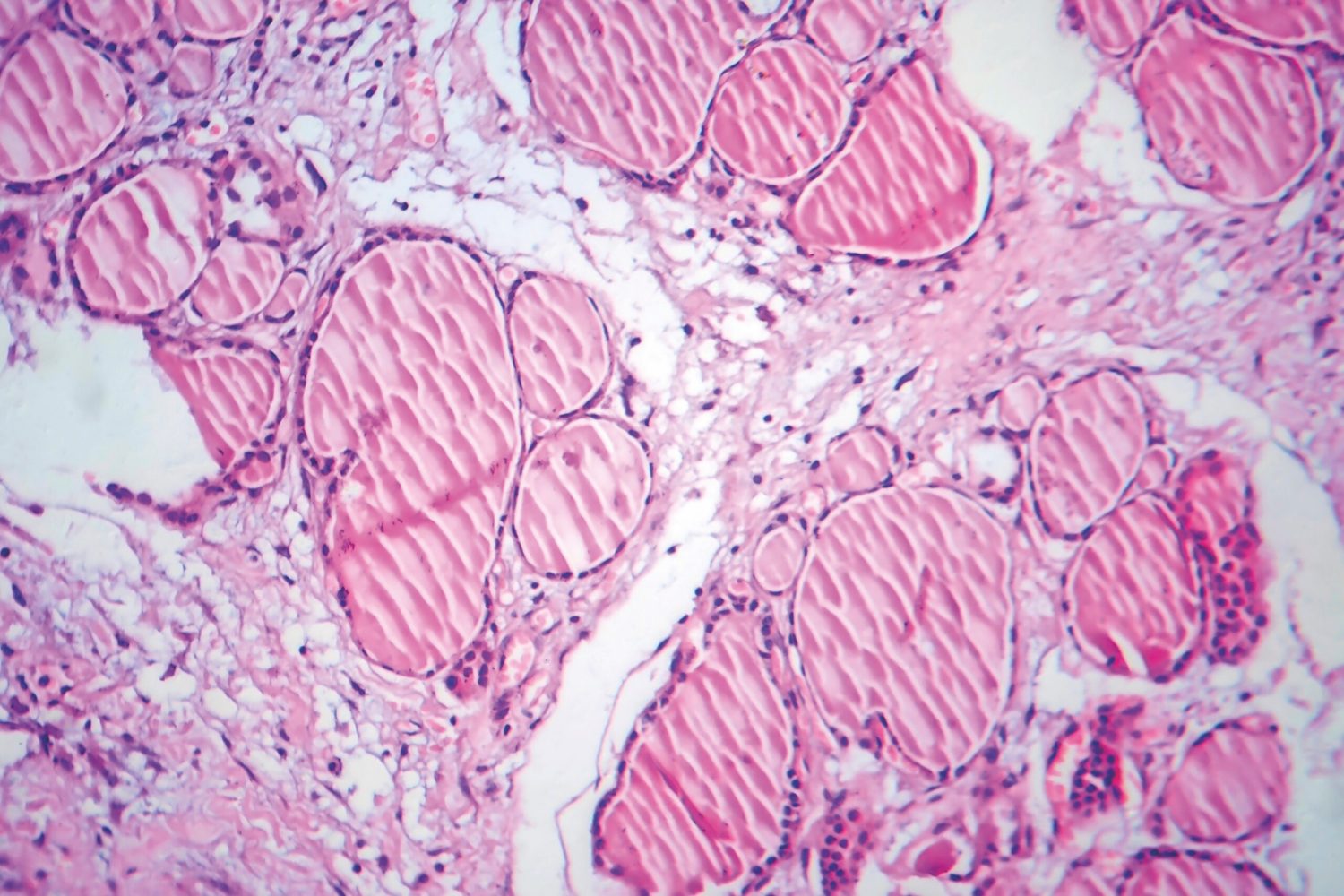 Fibrous thyroiditis, light micrograph, photo under microscope. A disease characterized by chronic inflammation and fibrosis of the thyroid gland